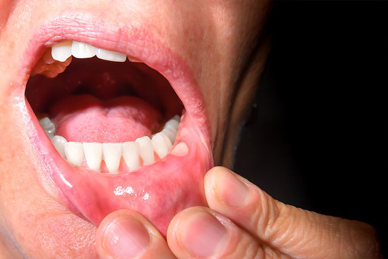 Investigating fungal infections in cancer patients receiving treatment in England - Pfizer